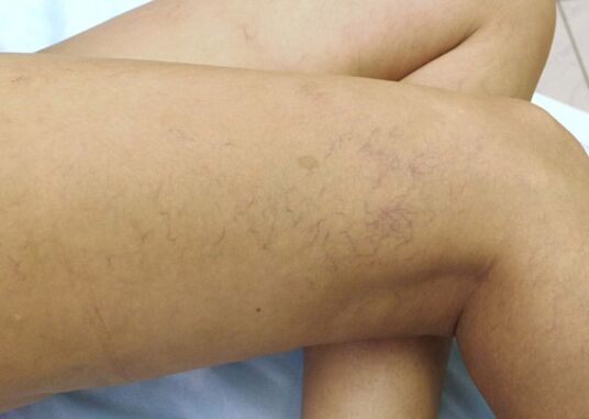 Kraujagyslių žvaigždės