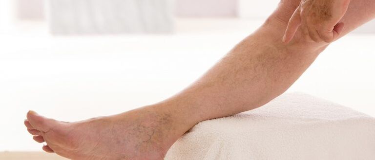 Varikozės venos ant kojų