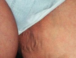 Dubens venų varikozė